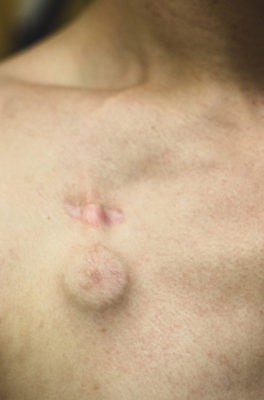 Der Dreiklang aus Wissenschaft, Patientenversorgung und Kommunikation ist das Leitmotiv für die alljährlich stattfindende Tagung der American Society of Clinical Oncology (ASCO). Diesem Anspruch wurde der Kongress – die weltweit größte onkologische Tagung – auch diesmal voll gerecht (1. - 5.6.2018 in Chicago).
