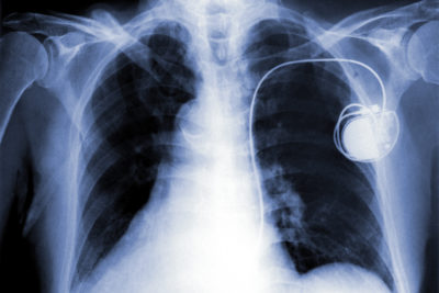 Bei sieben Herzschrittmachertypen von Medtronic kann es zu Stimulationspausen kommen. Eine Umprogrammierung könne den Fehler beheben.