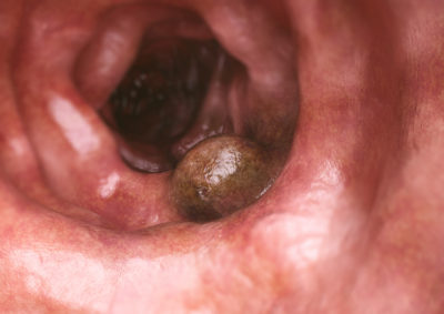 Patienten sind sich weitaus häufiger über den Nutzen von Präventionsmaßnahmen im Klaren als über die damit einhergehenden Risiken. Unklar ist, ob das an mangelnder Aufklärung oder am Erinnerungsvermögen begründet wird. 