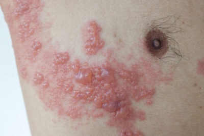 Herpes-Zoster ist weit verbreitet. Die G-BA denkt daher über eine Aufnahme in den Leistungskatalog nach.