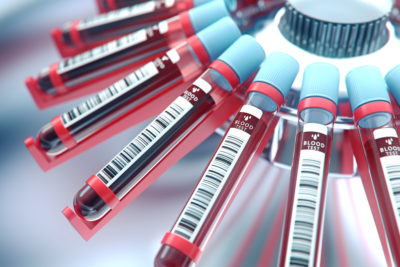 Ungerechtfertigt Hoffungen wecken - das ist gerade in der Medizin moralisch fragwürdig. Mit ihrer Ankündigung eines Bluttests auf Brustkrebs haben Mediziner genau das getan. Warum? Im Vordergrund könnten finanzielle Interessen stehen, wird zunehmend deutlich.