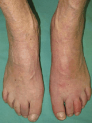 Aufgrund der Akuität eines ersten Gichtanfalls stellen sich die Patienten in der Regel notfallmäßig zuerst beim Hausarzt vor. Ihm kommt daher eine besondere Rolle bei der Diagnosestellung zu.