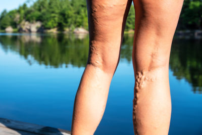 Venenerkrankungen wurden lange als "typische Alterserscheinung" eingeordnet und entsprechend auch bagatellisiert. Dieser Fehleinschätzung macht deren starke Zunahme ein Ende: als Volkskrankheiten werden sie immer bedeutsamer für die Hausarztpraxis.