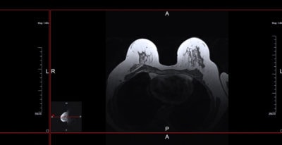 Seit heute übernehmen die Krankenkassen die Kosten für den Biomarker-Test bei Brustkrebs-Patientinnen.