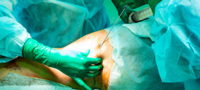 Die Kassen kommen künftig für die Kosten einer Liposuktion auf. Weil die Methode jedoch noch wenig untersucht ist, gelten strenge Voraussetzungen für die Operation. 