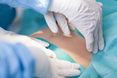 Die Techniker-Krankenkasse hat untersucht, wie gesund sich die Kinder ihrer Versicherten nach einer Sectio entwickeln. Das Ergebnis: Die Abrechnungsdaten zeigen höhere Risiken für Verhaltensstörungen, chronische Bronchitis und Allergien.