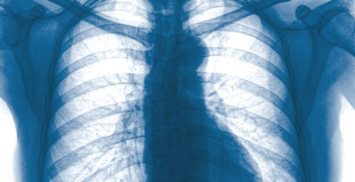 Die Fälle von mysteriösen Lungenerkrankungen in den USA gaben den Ermittlern Rätsel auf. Eine erste Spur führt zum Derivat eines lebenswichtigen Vitamin, das in den Produkten enthalten ist.