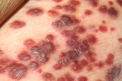 Hepatitis-C-Viren und das HI-Virus haben einen ähnlichen Übertragungsweg. So können Sie sich vor den Infektionskrankheiten schützen.