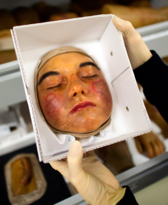 Systemischer Lupus erythematodes (SLE) ist eine Autoimmunerkrankung mit einem sehr breiten klinischen Erscheinungsbild. Das komplexe klinische Bild und die komplizierte Pathogenese machen es schwer, die Krankheit zu diagnostizieren. Die neuen EULAR-Klassifikationskriterien sollen dafür sorgen, dass SLE früher erkannt und behandelt werden kann.
