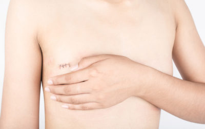Frauen mit hormonabhängigem Brustkrebs sollen Nebenwirkungen der antihormonellen Therapie mit Sport und gesunder Ernährung anstatt mithilfe von hormonhaltigen Präparaten lindern.