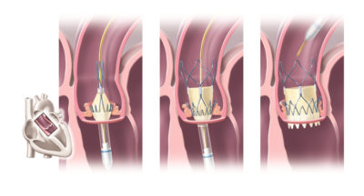 Bis Anfang 2019 galt TAVI bei Patienten mit mittlerem und hohem Op-Risiko als Therapie der Wahl zur Behandlung der Aortenklappenstenose. Niedrigrisikopatienten sollten jedoch weiterhin chirurgisch behandelt werden. Aufgrund zweier Studien stellen Experten diese Empfehlung jetzt infrage.