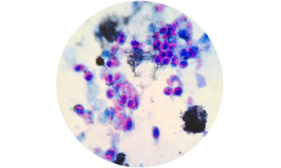 Das Neurodermitis-Mittel Dupilumab bietet Zusatznutzen bei chronischer Rhinosinusitis mit Nasenpolypen besagt eine Erhebung des Institut für Qualität und Wirtschaftlichkeit im Gesundheitswesen.