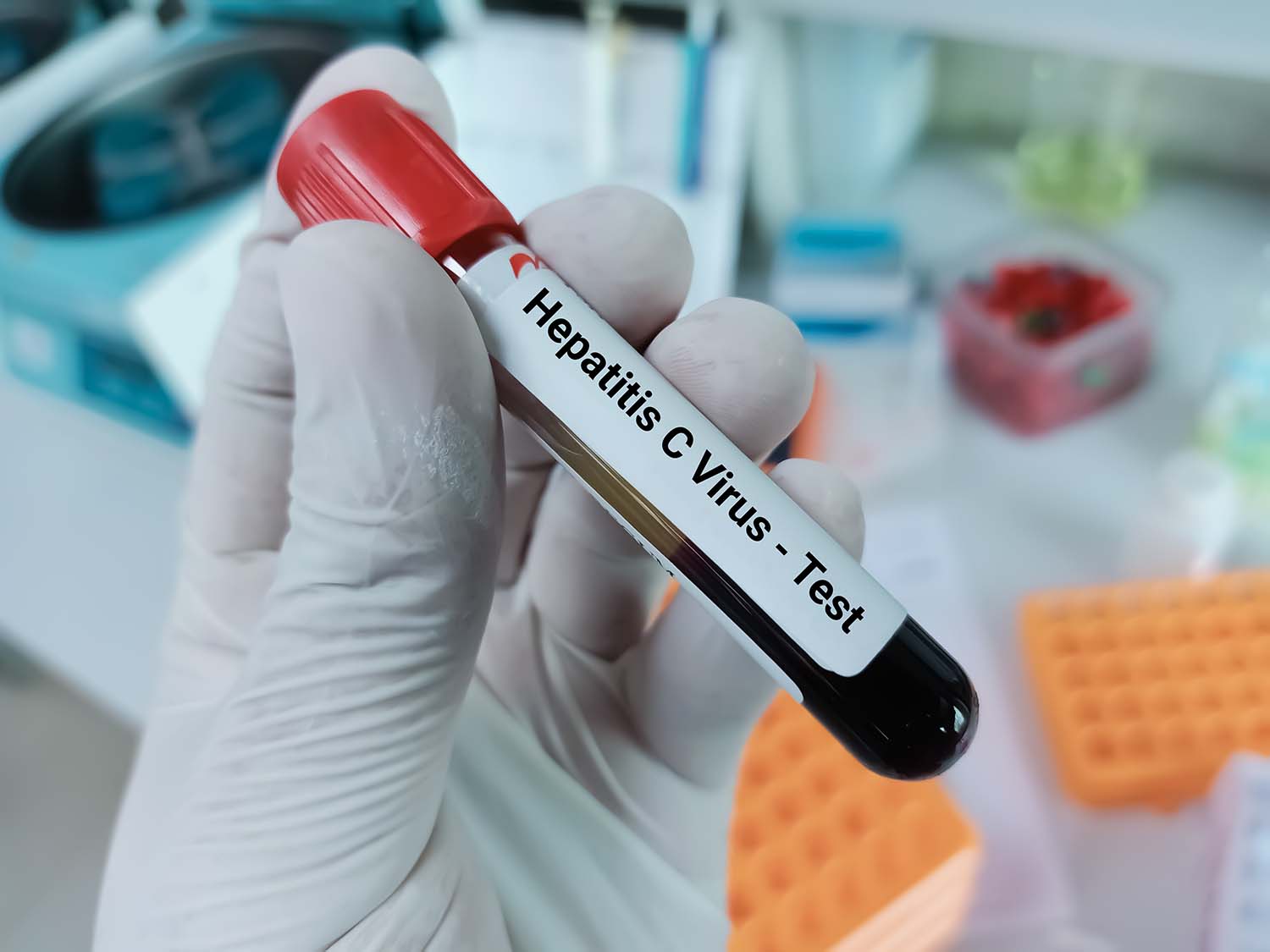 Im Rahmen der Gesundheitsuntersuchungs-Richtlinie kann die EBM Nr. 01865 zum Nachweis einer Hepatitis-B oder -C-Virusinfektion abgerechnet werden. Diese Möglichkeit wurde nun bis Ende 2028 verlängert.